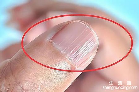 指甲上有竖纹是身体的什么信号怎么回事