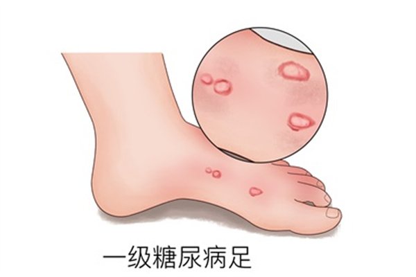 糖尿病的并发症有哪些？